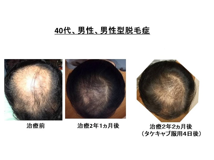円形脱毛症　病院""